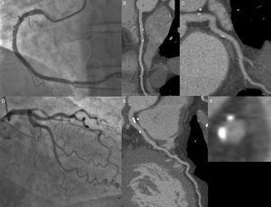 A 59-year-old man with hypertension as a coronary risk factor and typical chest pain. On invasive coronary angiography (panels A and D), mild lesions are observed in the mid and distal right coronary artery; in contrast, on computed tomography coronary angiography, mild predominantly calcified lesions are identified in the proximal, mid, and distal right coronary artery (panel B), left main coronary artery (asterisk, panels C, E, and F), proximal left circumflex (panel C), and proximal left anterior descending (panel E).
