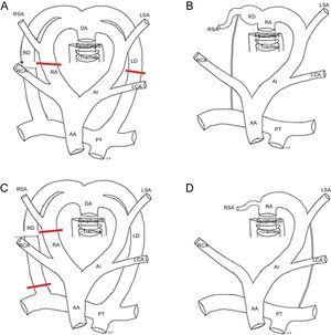 Hypothetical models and definitive diagrams. A and B: Left aortic arch with Kommerell diverticulum, aberrant subclavian artery, and right ductal ligament. C and D: Left aortic arch with aberrant right subclavian artery and left ductus (without vascular ring). AA, ascending aorta; DA, descending aorta; KD, Kommerell diverticulum; LCA, left carotid artery; LD, left ductus; LSA, left subclavian artery; PT, pulmonary trunk; RA, right arch; RCA, right carotid artery; RD, right ductus; RSA, right subclavian artery.