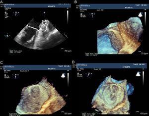 Two- and 3-dimensional transesophageal echocardiographic images of a thrombus located on the atrial side of the Amplatzer Cardiac Plug disc (A). B and C: Partial vision loss of the figure-of-8 shaped device mesh. D: After 2 months of low molecular weight heparin therapy, the figure-of-8 mesh image is recovered, indicating thrombus resolution.