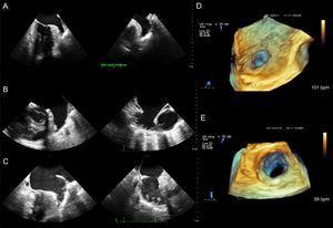 Left atrial appendage in various shapes and sizes. A-C: Two-dimensional transesophageal echocardiography, orthogonal planes. D and E: Three-dimensional view of the opening to the left atrial appendage.