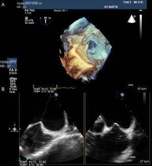 Three-dimensional (A) and two-dimensional (B) transesophageal echocardiography to monitor the transseptal puncture in the inferior-posterior portion of the fossa ovalis.