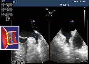 Landing zone diameter measured with 2-dimensional transesophageal echocardiography at 45° and 135° and at the same depth. The measurement is made 10 mm from the appendage ostium.