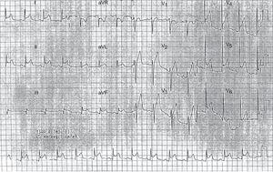 Electrocardiogram showing diffuse concave ST elevation and PR depression.