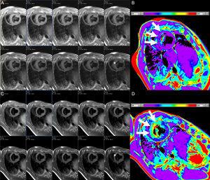 Consecutive short axis views of a T2-mapping sequence with increasing echo times (A and C, from left to right and superior to inferior) and corresponding T2 maps (B and D) in an animal at baseline (A and B), and after experimentally induced myocardial infarction (C and D). Note the different signal intensity with increasing echo times in the anteroseptum after the infarct but not at baseline (asterisks). The T2 maps demonstrate normal T2 values in the anteroseptum at baseline, but markedly increased after myocardial infarction (white arrows). The color bars indicate the color-coded range of T2 values. Images courtesy of Dr. Javier Sánchez-González.