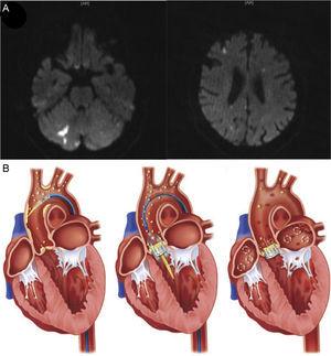 A: Post-TAVI cerebral diffuse weighted magnetic resonance imaging in an 82-year-old patient following successful TAVI, demonstrating acute ischemic lesions (hyperintense images) distributed across both hemispheres and within the anterior and posterior territories, suggesting an embolic etiology. B: Origin of embolization following TAVI. Aortic plaque or valve disruption during catheter and guidewire passages, thrombus formation during the procedure, and subacute thromboembolism originating directly from the native-transcatheter heart valve complex per se, atherosclerotic burden, or caused by chronic or new atrial fibrillation, are the main sources of emboli associated with TAVI. TAVI, transcatheter aortic valve implantation. From Kahlert et al.27 and Fanning et al.18 with permission.