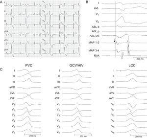 A: Twelve-lead electrocardiogram showing PVC; B: Intracardiac electrograms displaying an early fragmented (arrow) signal 15ms pre-QRS on the distal bipole of the MAP catheter located at the GCV/AIV junction. A far-field rounded signal 0ms pre-QRS was recorded on the distal bipole of the ABL catheter positioned at the left coronary cusp; C: Spontaneous PVC and pace-maps at the GCV/AIV junction and LCC with 97% and 92% concordance, respectively. ABL, ablation; AIV, anterior interventricular vein; GCV, great cardiac vein; LCC, left coronary cusp; MAP, mapping; PVC, premature ventricular contractions; RVA, right ventricular apex.