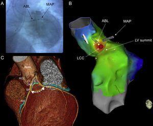 A: Left anterior oblique fluoroscopy view of the ABL catheter positioned at the LCC and the MAP catheter advanced out to the GCV/AIV junction. Coronary angiography revealed a safe distance between the ablation catheter and the major coronary vessels; B: Superior left lateral view of the CARTO 3 activation map showing the LV summit and the LCC where ablation was delivered (red disc); C: Computed tomographic image of the LV summit (reproduced with permission from Lin et al.5). ABL, ablation; AIV, anterior interventricular vein; GCV, great cardiac vein; LAD, left anterior descending coronary artery; LCC, left coronary cusp; LCx, left circumflex coronary artery; LV, left ventricular; MAP, mapping; RCC, right coronary cusp; SP, septal perforator.