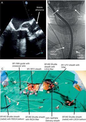 Embolic protection strategy in a particularly high-risk patient without any commercially available system. A: mobile atheroma is present on the calcific aortic valve leaflets. B: to protect the internal carotid arteries, two 6 Fr and 80-mm Shuttle sheaths were placed in the right common femoral artery to allow placement of bilateral internal carotid artery filter wires. Bilateral radial artery access was obtained with 6 Fr and 45-mm Shuttle sheaths, and balloons placed in the right and left subclavian arteries to protect the vertebral systems at the time of valve deployment as seen by fluoroscopy. C: the multiple radial and femoral sheaths are shown by external photograph. IMA, internal mammary artery; LFV, left femoral vein; LICA, left internal carotid artery; LSCA, left subclavian artery; RICA, right internal carotid artery; RSCA, right subclavian artery; RFV, right femoral vein; TPM, temporary pacemaker.