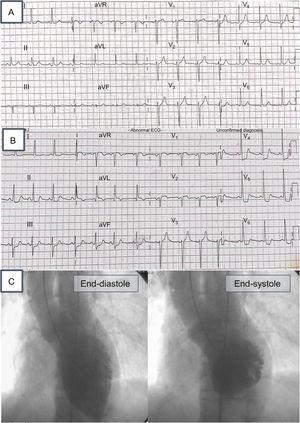 A: electrocardiogram at admission; B: electrocardiogram during pain; C: ventriculography showing inverted tako-tsubo pattern.