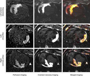 Cardiac magnetic resonance-based criterion standard images in the left anterior descending artery, left circumflex and right coronary artery myocardial territories using intracoronary gadolinium perfusion and inversion recovery sequences to visualize the anatomical area at risk.