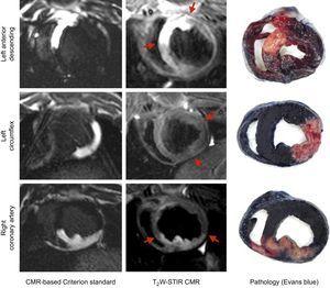 Comparison between the extent of area at risk visualized by the CMR-based criterion standard, T2W-STIR at day 7, and the pathology staining in each coronary territory. CMR, cardiac magnetic resonance; T2W-STIR, T2-weighted short tau triple-inversion recovery.
