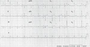 Electrocardiogram showing depressed PR segment and concave ST segment elevation in leads I, avL, and V3-V6.