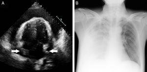 A: Echocardiogram showing severe diffuse pericardial effusion compressing both atria (arrows). B: Chest radiograph with massive right pleural effusion.