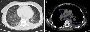 High-resolution lung computed tomography. A, Nodular ground-glass opacities with a centrilobular distribution and thickening of interlobular septa. B, Subcarinal mediastinal adenopathy, with a diameter up to 38mm.
