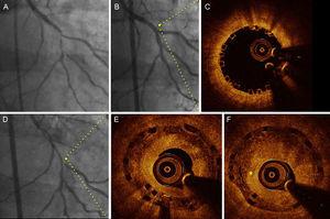 Angiographic (baseline, postbioresorbable vascular scaffold implantation and 14 months’ follow-up) and optical coherence tomography images (immediately after implantation and at follow-up) in a patient with diffuse restenosis A: Baseline angiography. B: Final result after bioresorbable vascular scaffold implantation (2.5 x 28mm) with provisional stent technique at bifurcation. C: Optical coherence tomography at the proximal segment exhibited optimal apposition and no fractures of the bioresorbable vascular scaffold. D: Angiographic study at follow-up. E: Optical coherence tomography at the proximal segment (same point of panel C) exhibited late overlapped struts and a layered pattern of neointimal tissue. F: Consecutive frame of E with the presence of neovascularization (asterisk).