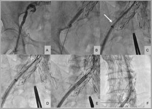 Implantation of an aortic valve prosthesis in a patient with peripheral vascular disease and trouser-like stenting at the iliac bifurcation. A: initial right femoral angiography. B: balloon angioplasty at the distal iliac border of the stent. C: collision of the introducer sheath with the distal-most extreme of the right iliac stent (arrow). D: buddy balloon technique for sheath introduction. E and F: valve introduction into the abdominal aorta.