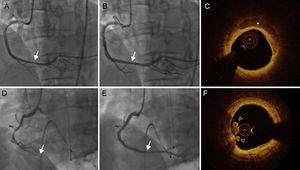 Coronary angiography and OCT images of a representative case of nonvasospastic angina (A, B and C) and vasospastic angina (D, E and F). Coronary angiography shows nonsignificant stenosis in the dRCA, which was diagnosed as non-VSA after intracoronary ergonovine injection (A) and nitroglycerin (B). C: OCT revealed superficial calcium (asterisk) on plaque without evidence of thrombus. D: Intracoronary ergonovine injection resulted in complete occlusion of the dRCA. E: This normalized with 200μg of intracoronary nitroglycerine administration. F: OCT revealed a protruding mass into the lumen of white thrombus (arrow head) with an intact fibrous cap and an irregular luminal surface. dRCA, distal portion of the right coronary artery; OCT, optical coherence tomography.