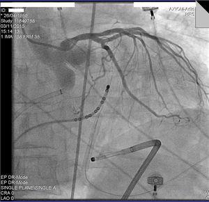 Left coronary angiography in the anteroposterior view with an Orion catheter in the pericardial sack.