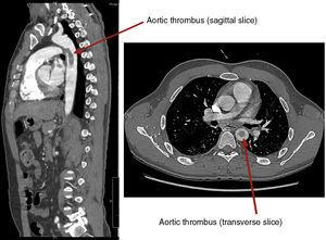 Sagittal and transverse images of aortic thrombus.