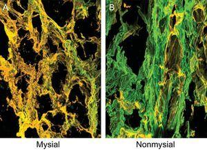 Endomyocardial tissue from 1 patient with severe AS with PEF and symptoms of HF. Sections were stained with specific monoclonal antibodies against collagen types I and III and the fibers were identified in green and yellow, respectively, on confocal microscopy. A: Corresponds to the mysial region of the collagen network. B: Corresponds to the nonmysial region of the collagen network. Magnification × 60. AS, aortic valve stenosis; HF, heart failure; PEF, preserved ejection fraction.