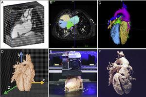 Three-dimensional (3D) printing sequence. A: 3D radiological imaging. B: Cardiac tissue segmentation. C: 3D rendering of the segmented cardiac anatomy. D: Computer-assisted design. E: Printing by fused deposition modeling. F: Final 3D model.