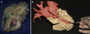 A: Hybrid 3-dimensional (3D) model created from computed tomography and 3D echocardiography images to obtain the blood volume and the tricuspid and mitral valves (green and pink, respectively). Reproduced with permission from Gosnell et al.16 B: 3D model representing the left ventricular myocardium (ochre) and the right atrium and aorta (red).
