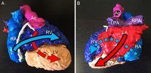 Three-dimensional (3D) model of a heart with criss-cross atrioventricular connections. A: Anterior view. B: Posterior view. The model shows the contralateral positions of the right atrium (RA) and right ventricle (RV) and of the left atrium (LA) and left ventricle (LV), with the associated crossing of the inflow tracts (arrows). Ao, aorta; LPA, left pulmonary artery; RPA, right pulmonary artery.