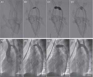 Stent placement in a 15-year-old male patient with aortic arch hypoplasia. Comparison of preintervention simulation with a 3-dimensional printed model (A1-D1) and the real intervention in the patient (A2-D2). Reproduced with permission from Valverde et al.10
