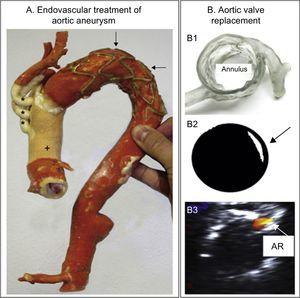 A: 3-dimensional (3D) model after the frozen elephant trunk procedure to treat an extensively atherosclerotic aortic aneurysm. The image shows the prosthetic ascending aorta (+) and supraaortic trunks (*) and the aortic arch stenting (arrows). Reproduced with permission from Schmauss et al.36 B1: 3D model evaluating aortic root and coronary artery morphology. B2: Retrospective prediction of paravalvular aortic regurgitation (arrow) by shining light on a printed Edwards-SAPIEN valve positioned in the 3D model. B3: Transesophageal echocardiography in the patient showing residual aortic regurgitation (AR) after valve placement. Reproduced with permission from Ripley et al.50