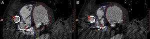 Postprocessing of the biventricular systolic function analysis. End-diastolic (A) and end-systolic (B) endocardial contours manually traced in the short axis covering both ventricles. Ejection cannula (#) making an impression on the lateral wall of the right ventricle. Electrode from implantable cardioverter defibrillator (+).
