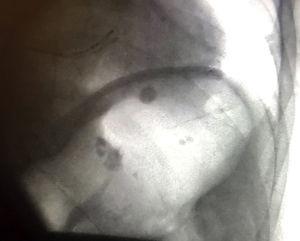 Image of fluoroscopy showing gastric bubble distension.