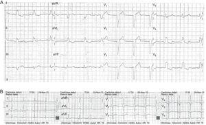 A: Electrocardiogram performed following initiation of formoterol treatment, showing sinus rhythm and complete left bundle branch block. B: Electrocardiogram following discontinuation of formoterol, showing sinus rhythm without left bundle branch block.