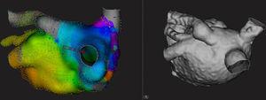 Posterior views of variant pulmonary vein anatomy revealed by electroanatomic mapping (left) and 3-dimensional computed tomography reconstruction (right) of the left atrium. A left superior pulmonary vein opens in the atrial roof, showing evidence of dilatation and a proximal curvature that could interfere with multipolar catheter mapping. The Orion catheter allowed exploration of the 4 veins observed. Mapping time, 24minutes.