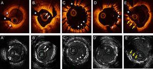 The upper row of images shows the findings from optical coherence tomography, and the lower row of images shows the findings from high-definition intravascular ultrasound. A and A’ show an area of fibrocalcified plaque in the left anterior descending artery, where 2 calcified nodules are demarcated (+). B and B’ show the immediate result after semicompliant balloon predilatation of a severely calcified lesion in the circumflex artery, with an image of an intimal flap (arrows) compatible with dissection. C and C’ show the result at 9 months post implantation of a drug-eluting stent in the proximal right coronary artery, demonstrating the absence of strut endothelialization in 2 thirds of the circumference, as well as an area of malapposition (arrowheads). D and D’ show the development of evaginations (e) in a drug-eluting stent implanted 9 months earlier. E and E’ show an area of underexpansion in a drug-eluting stent implanted 9 months earlier, due to the presence of a highly-calcified eccentric plaque (arrows). *Artefact from guidewire.