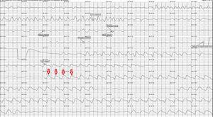 Chest compression waves visible in the tracings. The arrows indicate the waves recorded in the tracings that are due to the performance of CPR maneuvers. Two cycles of 30 compressions and 1 pause can be seen, presumably because the standard 30:2 compression-to-ventilation ratio was being followed. CPR, cardiopulmonary resuscitation.