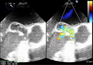 Transesophageal echcoardiogram. Long-axis aortic view at 140°. There is a pseudoaneurysm of the anterior leaflet of the mitral valve. TEMP PCTE, temperature patient; TEMP TEE, temperature transesophageal echocardiography.