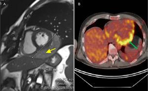 Multimodality imaging. A: MRI. Gradient-echo MRI sequence showed a well-delimited mass (arrow) located into the posterior-lateral pericardium. B: FDG-PET. Transverse plane image is shown. Enhanced uptake can be seen in the pericardial mass. FDG-PET, 18-fluorodeoxyglucose positron emission tomography; MRI, magnetic resonance imaging.