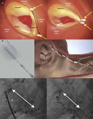 Percutaneous annuloplasty devices. A: Trialign: suture pledgets (yellow arrows) anchored at the TV annulus (left). Reduction of the tricuspid annular dimension after plication of the posterior leaflet (right). Reprinted with permission from Schofer et al.37 B: TriCinch device (left). Illustration of TriCinch implantation (right). Reprinted with permission from Rodés-Cabau et al.28 C: Cardioband: Fluoroscopic images after device implantation, before (left) and after (right) cinching, with significant reduction of tricuspid annulus diameter. *, Coronary wire in the right coronary artery. #, Cardioband cinching catheter. Reprinted with permission from Schueler et al.45