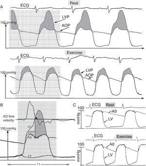 A: Deep left ventricular (LVP) and aortic root (AOP) pressures in hypertrophic cardiomyopathy at rest and during supine bicycle exercise, which elicits an abnormal LVP diastolic decay, suggesting impaired ventricular relaxation; LVP decays throughout diastole, in sharp contrast to the normal pattern shown in panel C. B: Pressure-flow relation with large early and enormous mid- and late-systolic dynamic gradients in hypertrophic cardiomyopathy. From top downward: aortic velocity signal, and deep left ventricular (LV), left ventricular outflow tract (LVOT), and aortic root (AO) micromanometric signals, measured by retrograde triple-tip pressure plus velocity multisensor left-heart catheter. Left atrial (LA) micromanometric signal was measured simultaneously by trans-septal catheter. The vertical straight line identifies the onset of SAM-septal contact, determined from a simultaneous M-mode mitral valve echocardiogram (not shown); the majority of aortic ejection flow is already completed by this time. The huge mid- and late- systolic gradient (hatched area) is maintained in the face of minuscule remaining forward or even negative aortic velocities. SAM, systolic anterior motion of the mitral valve. Adapted from Pasipoularides,3 with permission of PMPH-USA.