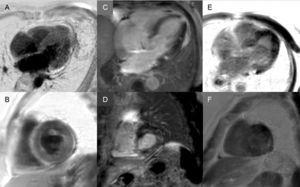 Diversity of late enhancement patterns by cardiac magnetic resonance imaging in transthyretin amyloidosis. A and B: late enhancement sequences, 4-chamber plane and short axis at the mid level, respectively, of a patient with mutant transthyretin amyloidosis (ATTRm), showing diffuse pathological transmural gadolinium deposition. C and D: late enhancement sequences, 4-chamber and short-axis basal level, respectively, of patients with ATTRm showing pathological gadolinium deposition with a patched pattern, with lower inferoseptal and inferolateral basal focal area. E and F, late enhancement sequences, 4-chamber plane and short axis at the apical level, respectively, of patients with ATTRm, showing extensive pathological transmural deposition, except in basal and middle anterolateral segments. Courtesy of Dr Jesús González Mirelis.