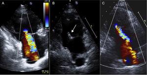 Images showing TR severity before and after attachment of 2 clips. A: 4/4 TR before the procedure. B: imaging after clip attachment (arrow). C: 2/4 TR at 2 months postprocedure. TR, tricuspid regurgitation.