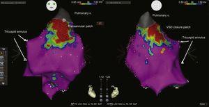 Voltage map of the right ventricle in an anterior (AP) and posterior (PA) image. Scarring area from the pulmonary valve to the anterior outflow tract (ventriculotomy scar and infundibular resection) and another posterior septal scar zone from the VSD closure patch. The yellow dots show the bundle of His. VSD, ventricular septal defect; V, valve.