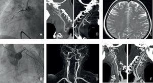 A and B: occlusion of the proximal right coronary artery and vasospasm of the left anterior descending artery in the coronary angiogram. C and D: severe bilateral stenosis of the extracranial internal carotid arteries in the computed tomography angiogram and magnetic resonance angiogram. E: Multiterritorial cerebral infarctions in the brain magnetic resonance imaging. F: normal lumen of the bilateral internal carotid arteries.