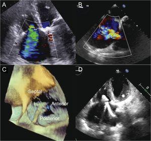 Screening echocardiography and procedure. A and B, TTE and TEE show severe RT. C, positioning and orientation of the clip in 3-dimensional TEE to capture the anterior and septal veils. D, grasping in TTE. TEE, transesophageal echocardiography; TTE, transthoracic echocardiography; TR, tricuspid regurgitation.
