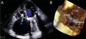 Result of the procedure. A, mild tricuspid regurgitation on predischarge echocardiography. B, 3-dimensional TTE showing the bridge formed by the clip between the septal and anterior leaflets. TTE, transthoracic echocardiography.