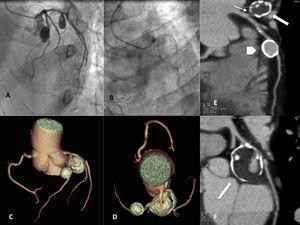 A and B, coronary angiography; aneurysmal dilatations in the proximal segment of the left anterior descending artery and the circumflex artery. C and D, computed tomography angiography showing 2 calcified, saccular, coronary artery aneurysms; the larger one is located in the circumflex artery. E and F, multiplanar reconstructions. Circumflex artery aneurysm, 30×24mm in size (arrows), with a narrow neck (E, thin arrow), calcified wall (“eggshell” appearance), thrombus (interior, low-density area) and irregular residual lumen; 15×14mm aneurysm in the left anterior descending artery (E, arrowhead), also showing a calcified wall.