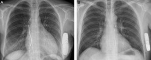 Chest radiography of a patient with right parasternal lead implantation (A) and of a patient with left parasternal implantation (B).