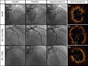 Cases of the 3 groups of therapy received: A: No MF; B: MF + non-ITDM; C: MF + ITDM. Column 1 represents angiography images pre-PCI, column 2 post-PCI, column 3 angiography at 9 months, and the last column represents OCT images at 9 months. Green arrows point to covered struts. Red arrows represent uncovered struts. The asterisk represents the wire artefact. FU, follow-up; ITDM, insulin-treated diabetes mellitus; MF, metformin; non-ITDM, noninsulin treated diabetes mellitus; OCT, optical coherence tomography; PCI, percutaneous coronary intervention.