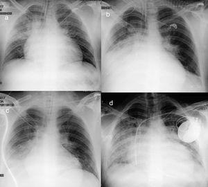 Ultrasound-assessed Pulmonary Contusion After CPR | Revista Española de ...