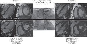 Changes in ejection fraction on magnetic resonance imaging 3 months after the procedure in a patient with chronic occlusion of the RCA and LAD, which were recanalized in 2 stages. EDV, end-diastolic volume; ESV, end-systolic volume; LAD, left anterior descending artery; LVEF, left ventricular ejection fraction; RCA, right coronary artery.